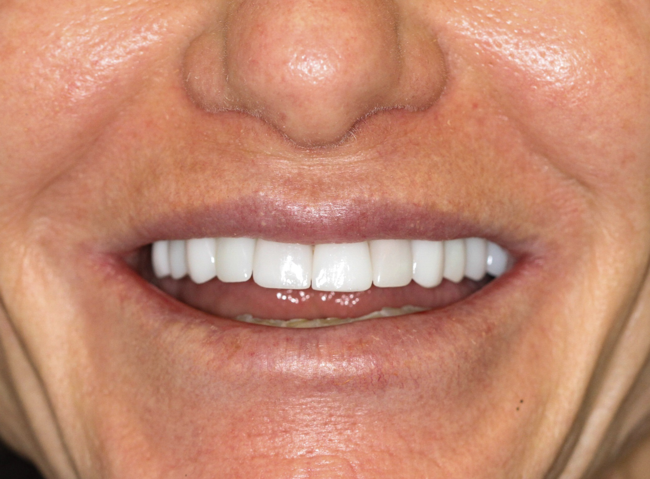 After dental implant &mdash; restored natural-looking smile