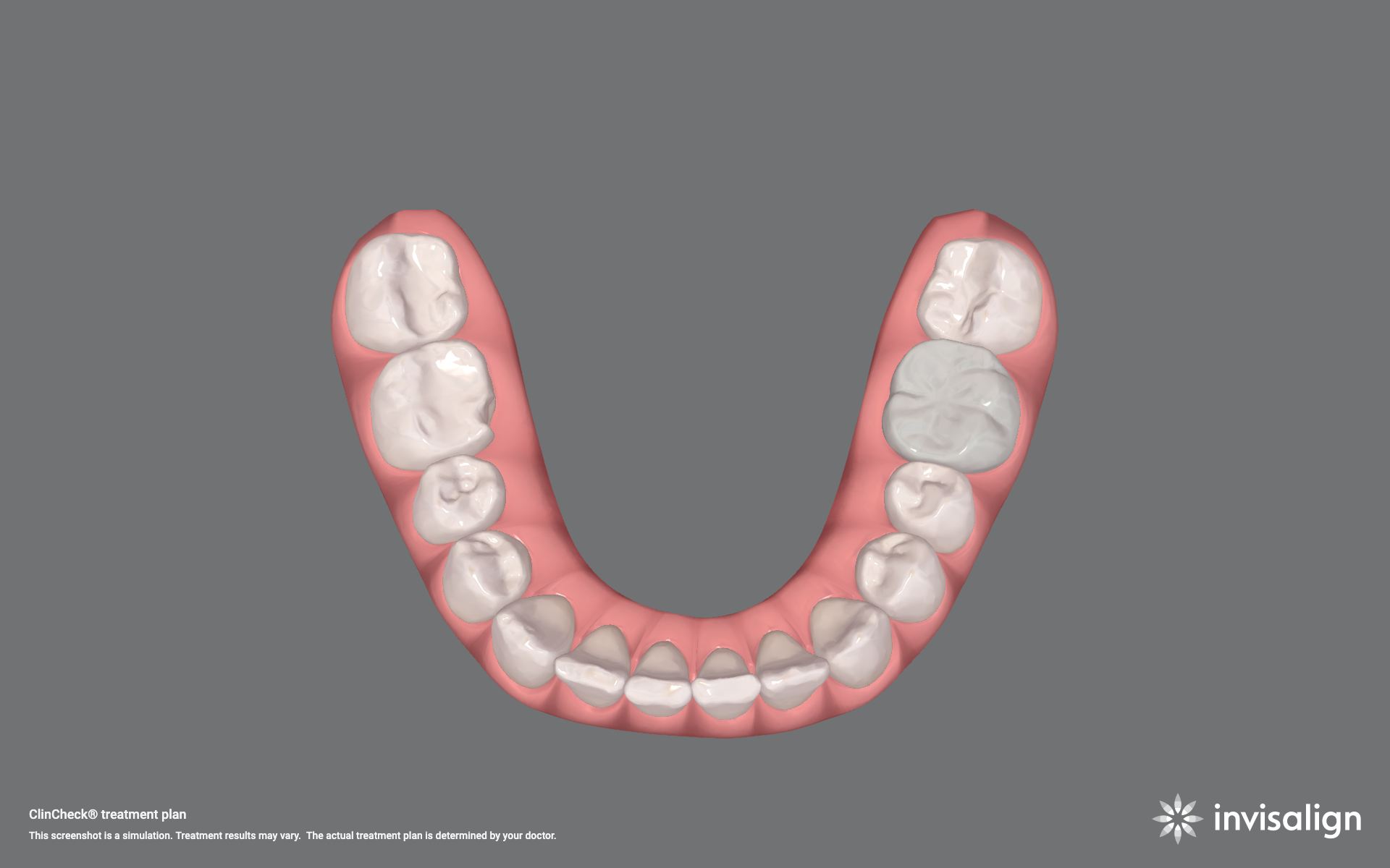 Invisalign after &mdash; aligned smile after clear aligner treatment