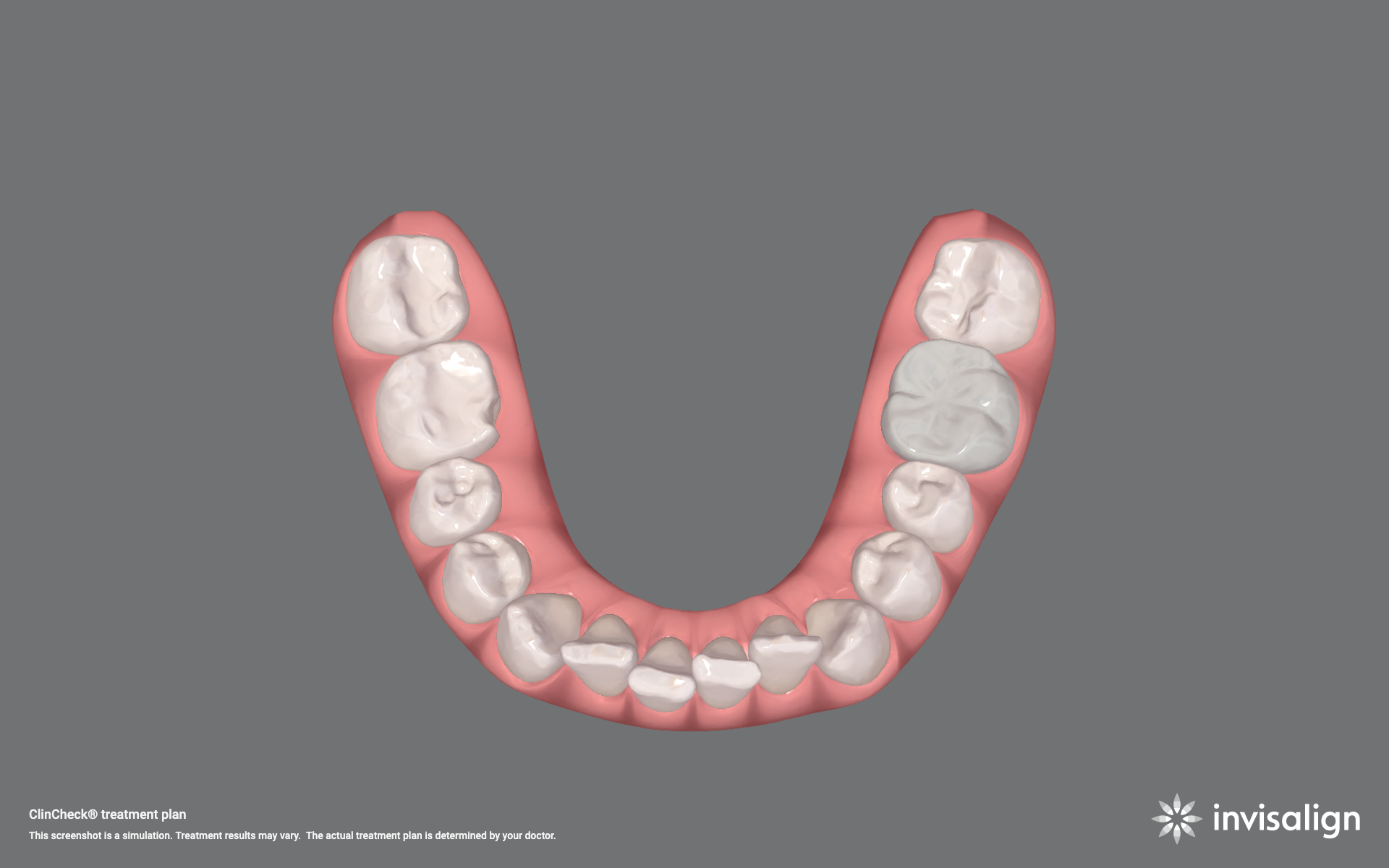 Invisalign before &mdash; crowded teeth at Agoura Hills Dental Designs
