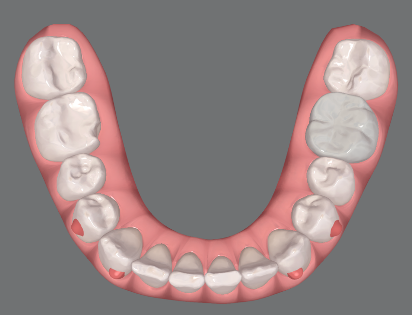 Simulated patient smile after Invisalign treatment