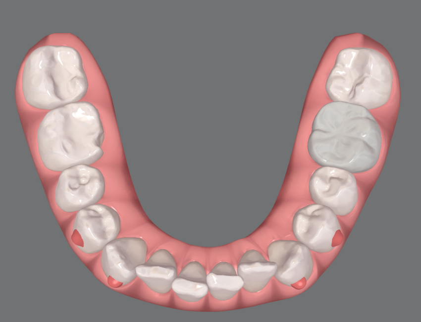 Patient smile before Invisalign treatment