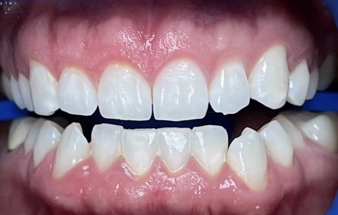 Teeth whitening after &mdash; dramatically brighter smile