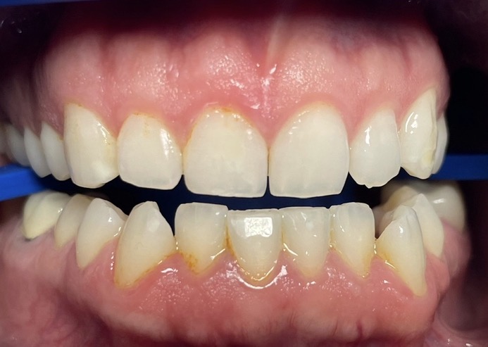 Teeth whitening before &mdash; Agoura Hills Dental Designs patient