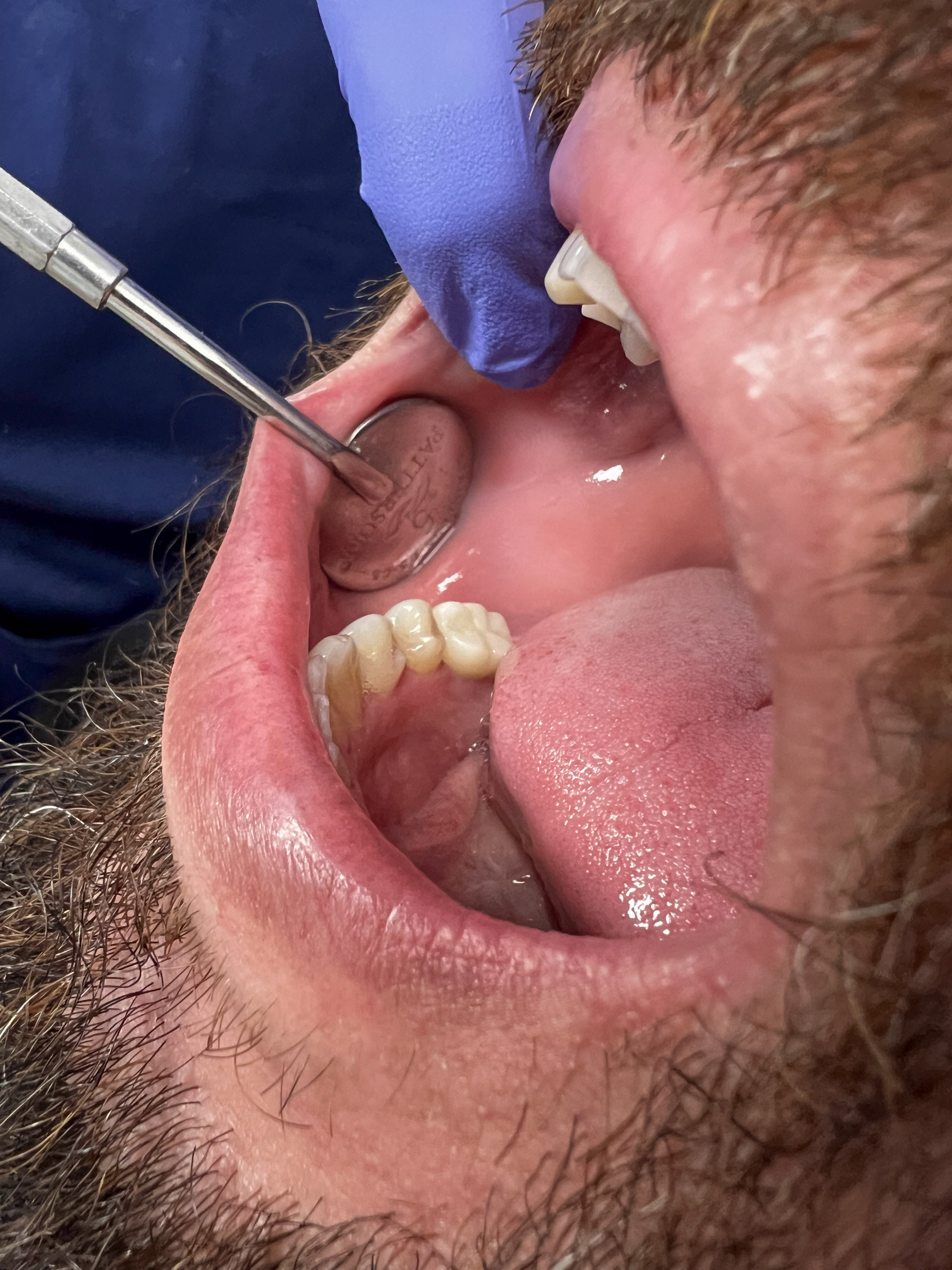 After dental implant &mdash; restored natural-looking smile