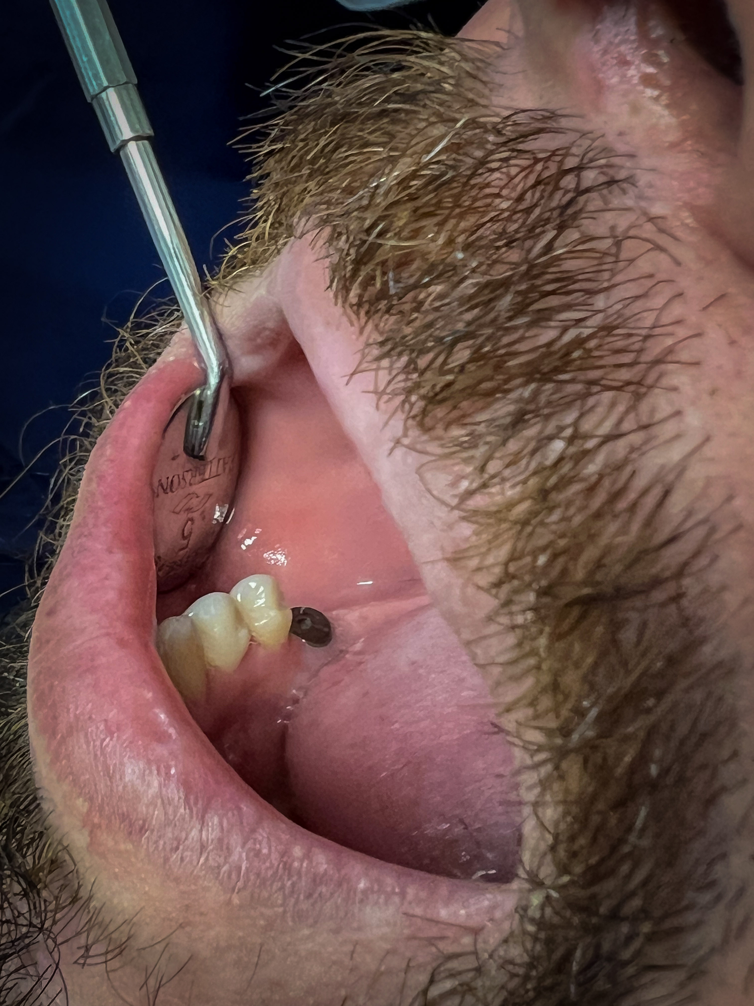 Before dental implant &mdash; missing tooth