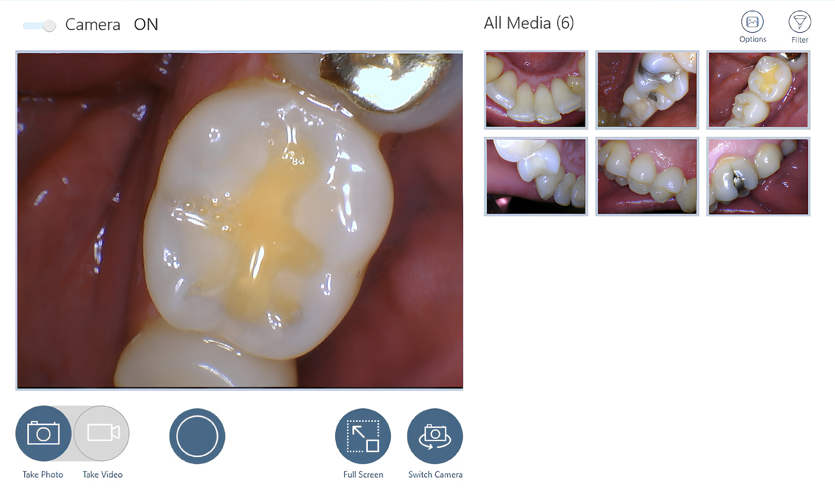 HD intraoral camera in clinical use