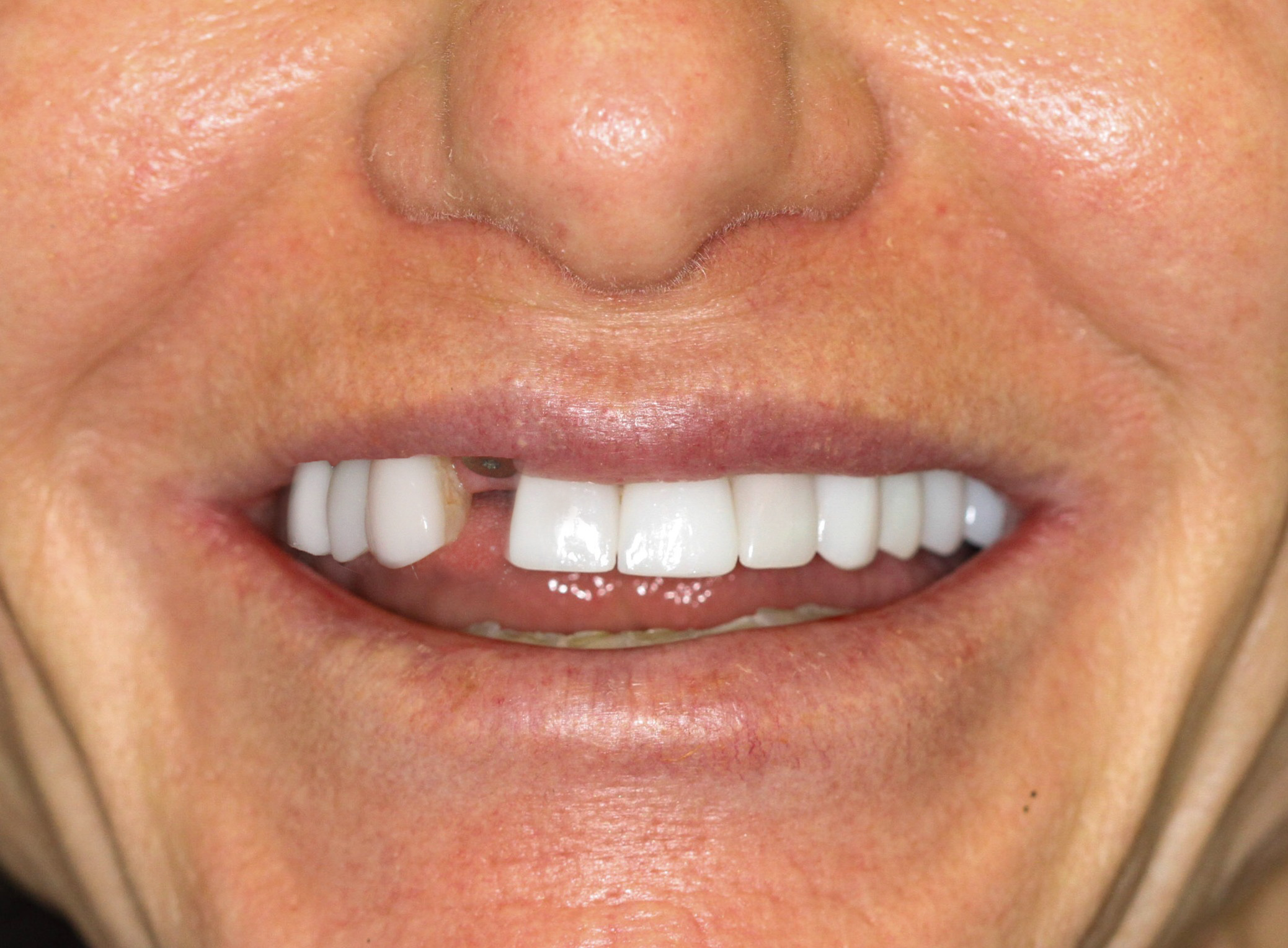 Before dental implant &mdash; missing tooth
